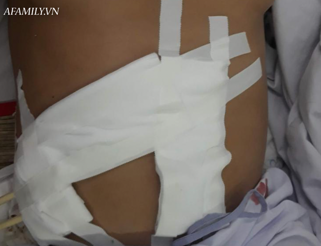 Bị tăng huyết áp và nữ hoá tuyến vú, người đàn ông suýt chết vì khối u lớn 'khủng khiếp' ở thận - Ảnh 1.