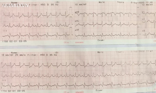 Vô tình gãy xương đùi, người phụ nữ nhập viện mới biết suýt chết vì căn bệnh rất nguy hiểm ở phổi - Ảnh 2.