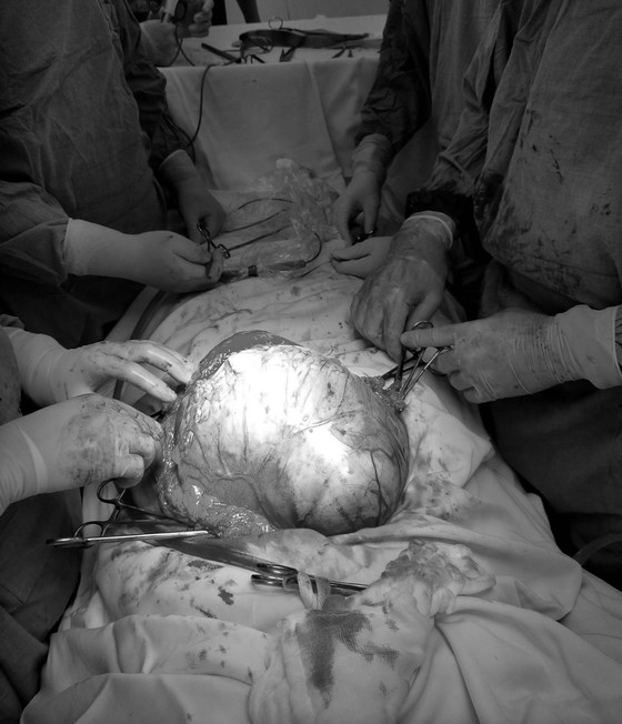 Ung thư buồng trứng giai đoạn muộn vì chủ quan ảnh 1